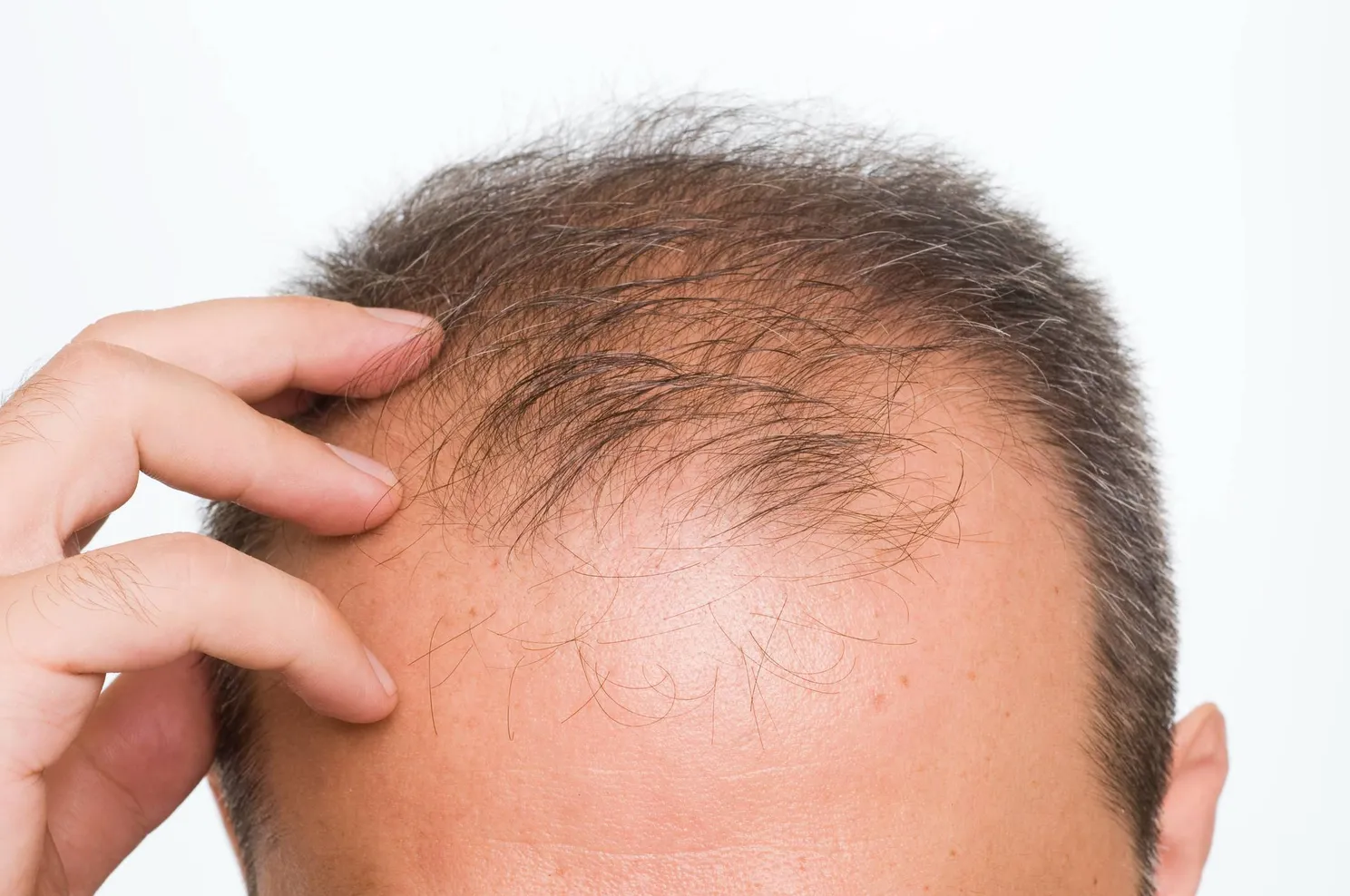 balding-istock