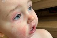 Mama waarschuwt andere ouders nadat zoontje (1,5) wekenlang aan zeldzame aandoening lijdt: "Hoge koorts, rode ogen en overal uitslag"