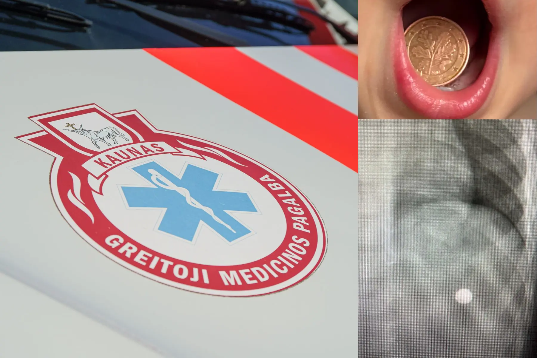 Greitoji medicinos pagalba, vaikas, svetimkūnis, rentgenas