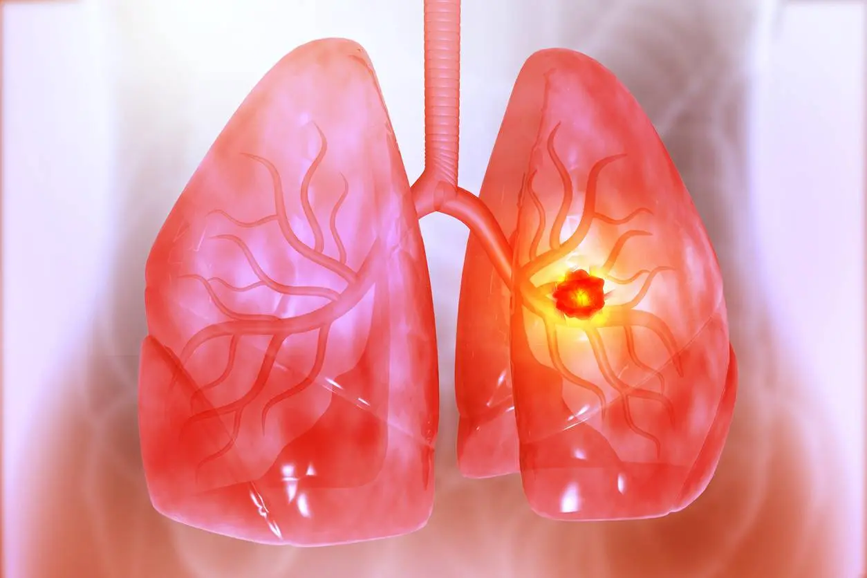 Cemiplimab Regimen Extends Survival in Advanced NSCLC