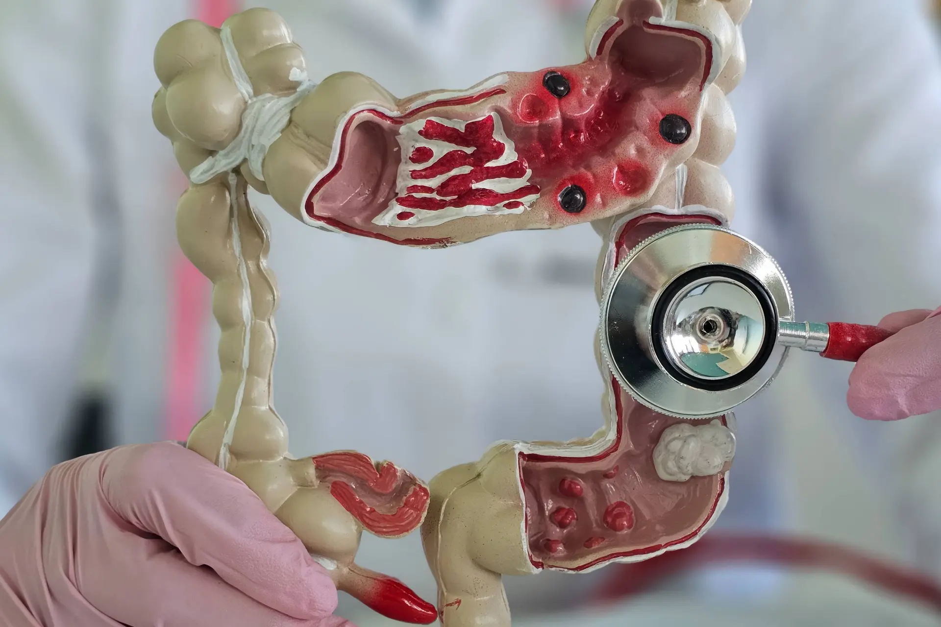 Cetuximab Combination Improves PFS in Metastatic Colorectal Cancer
