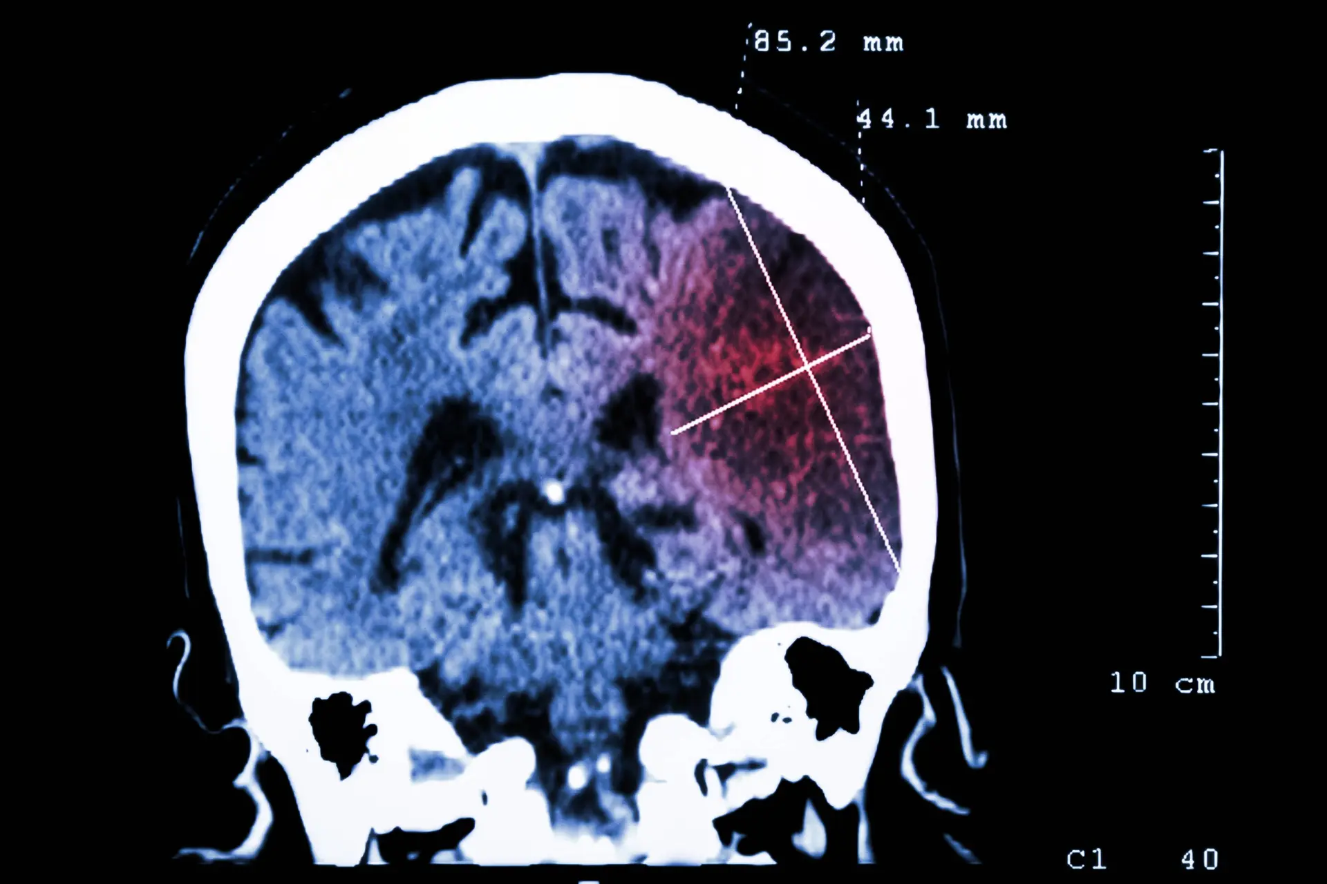 Left Atrial Appendage Closure Linked to Higher Ischemic Stroke Risk
