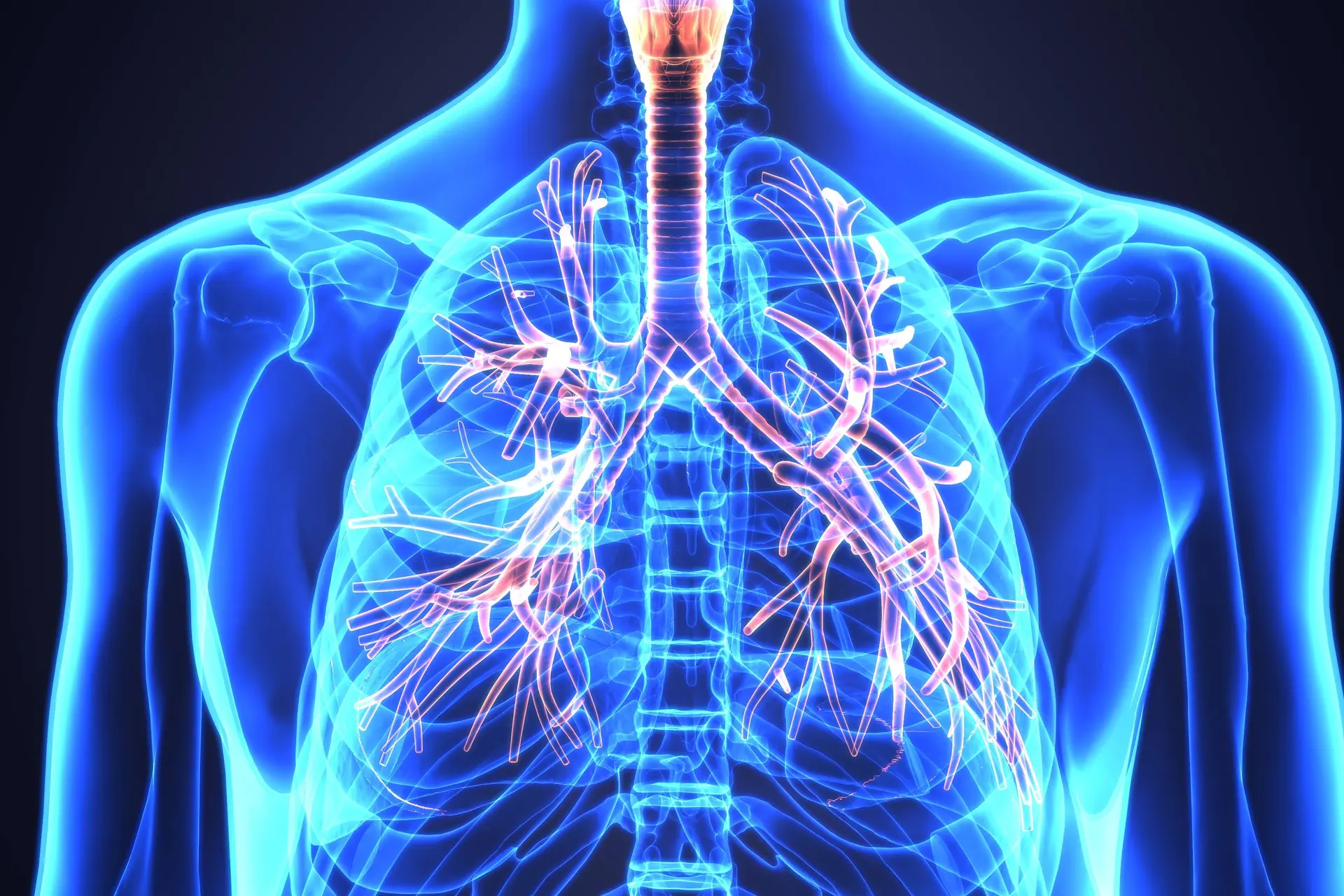 CHEST Issues Adult Bronchiectasis Guideline