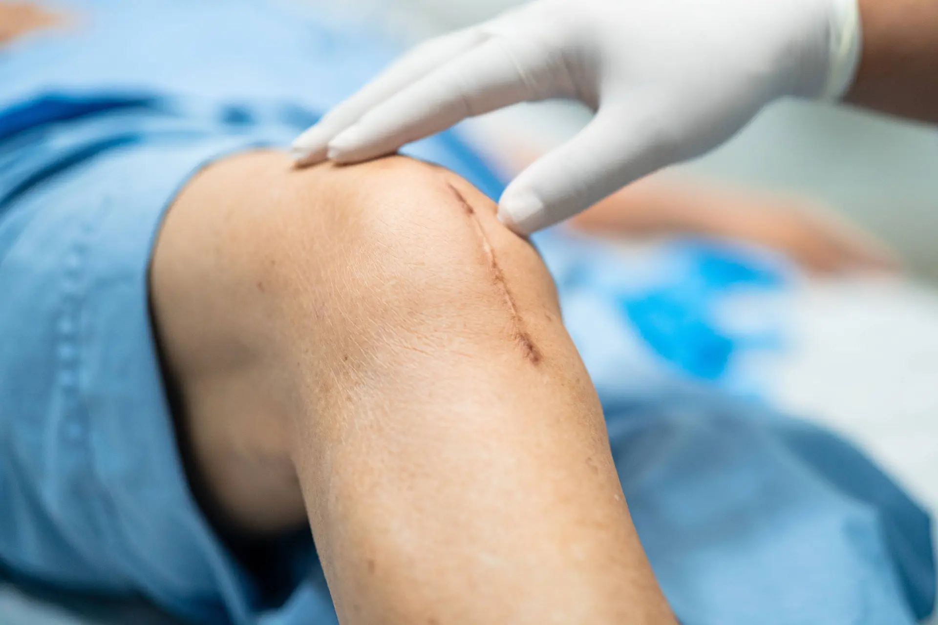 Aspirin Noninferior to Rivaroxaban Strategy After Arthroplasty