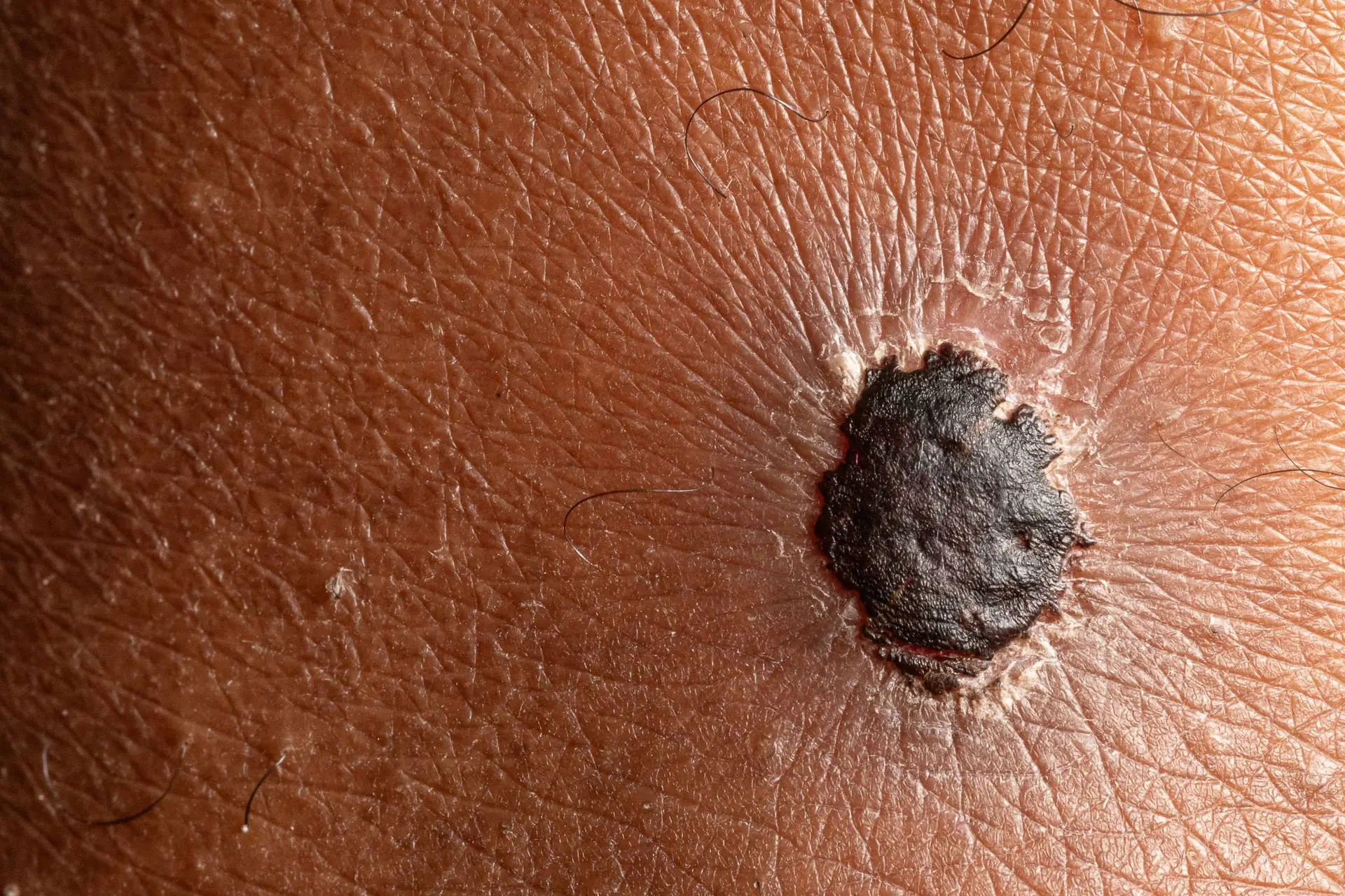 Daromun Extends RFS in Resectable Melanoma