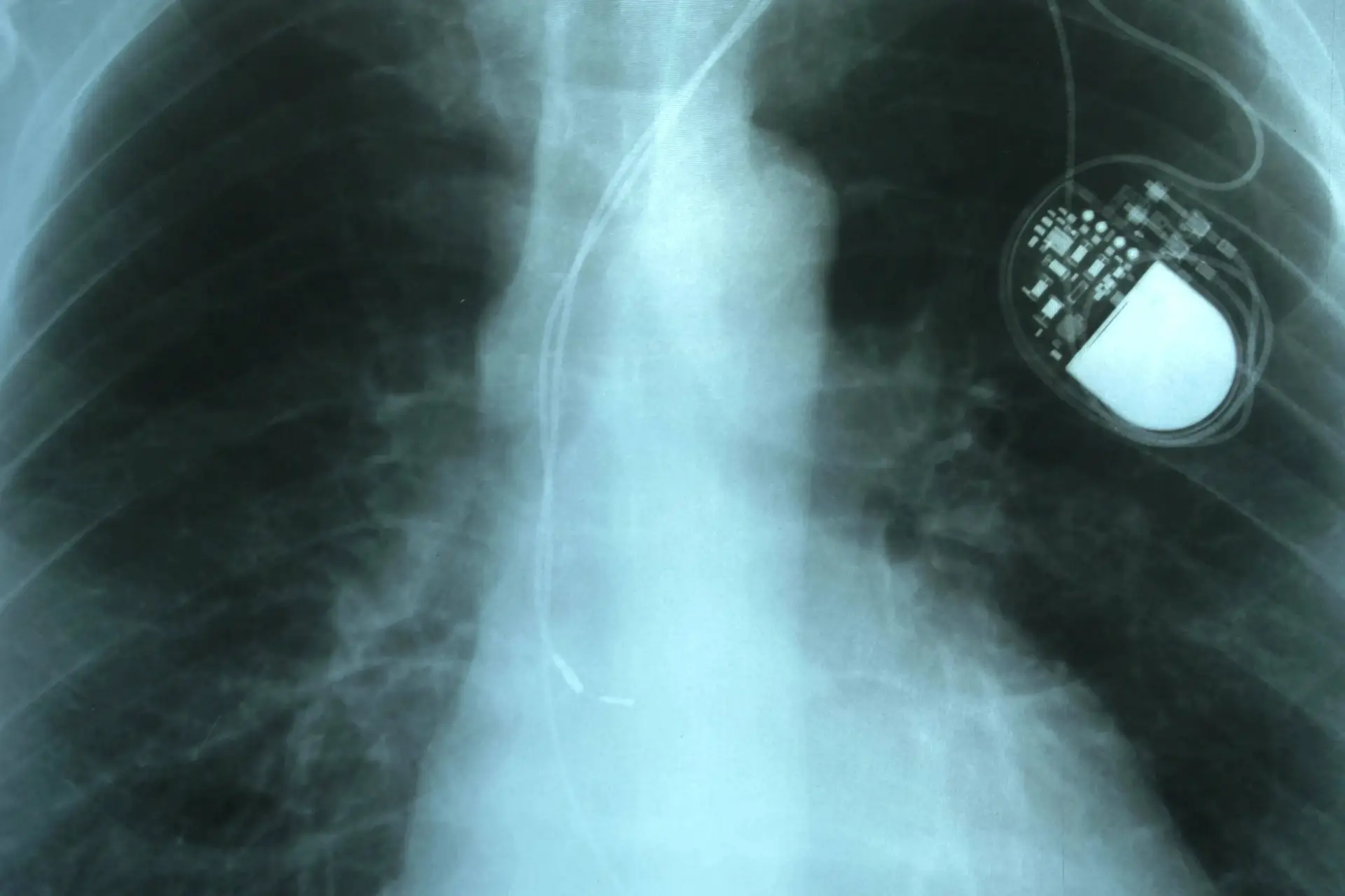 LBBP Outperforms Right Ventricular Pacing in Trial