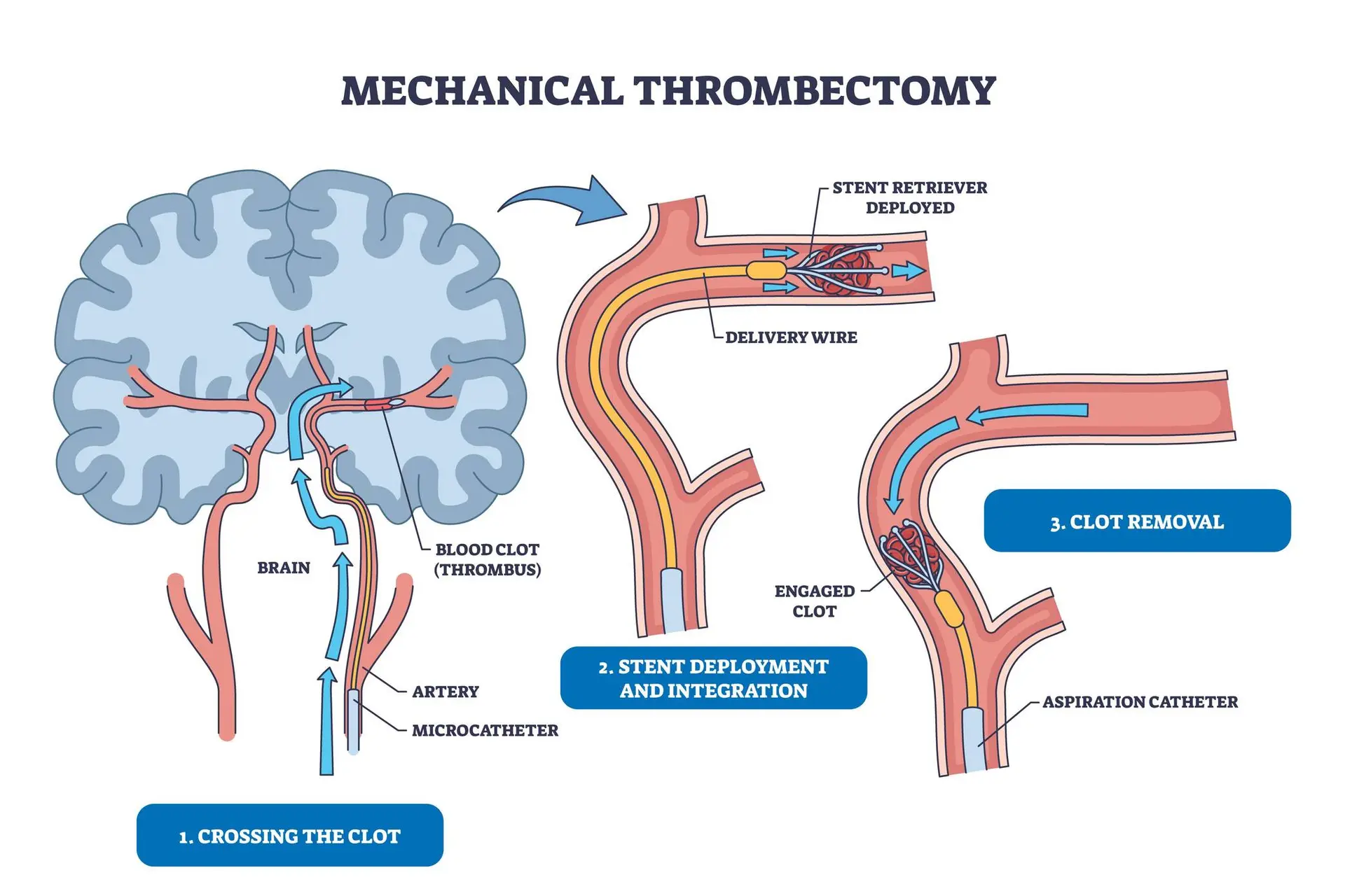 Thrombectomy Fails to Improve Medium or Distal Stroke