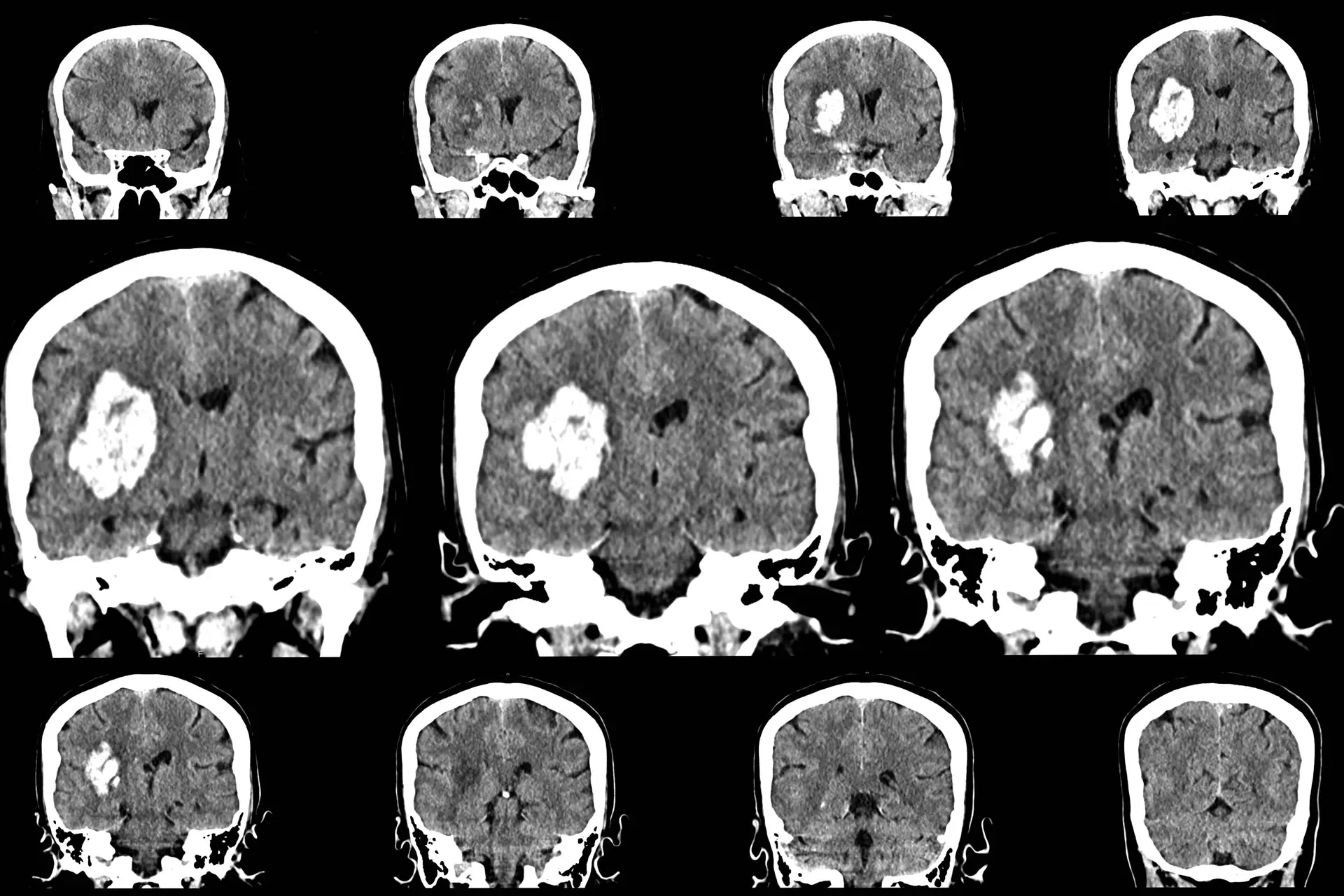 Loberamisal Improved 90-Day Function After Ischemic Stroke