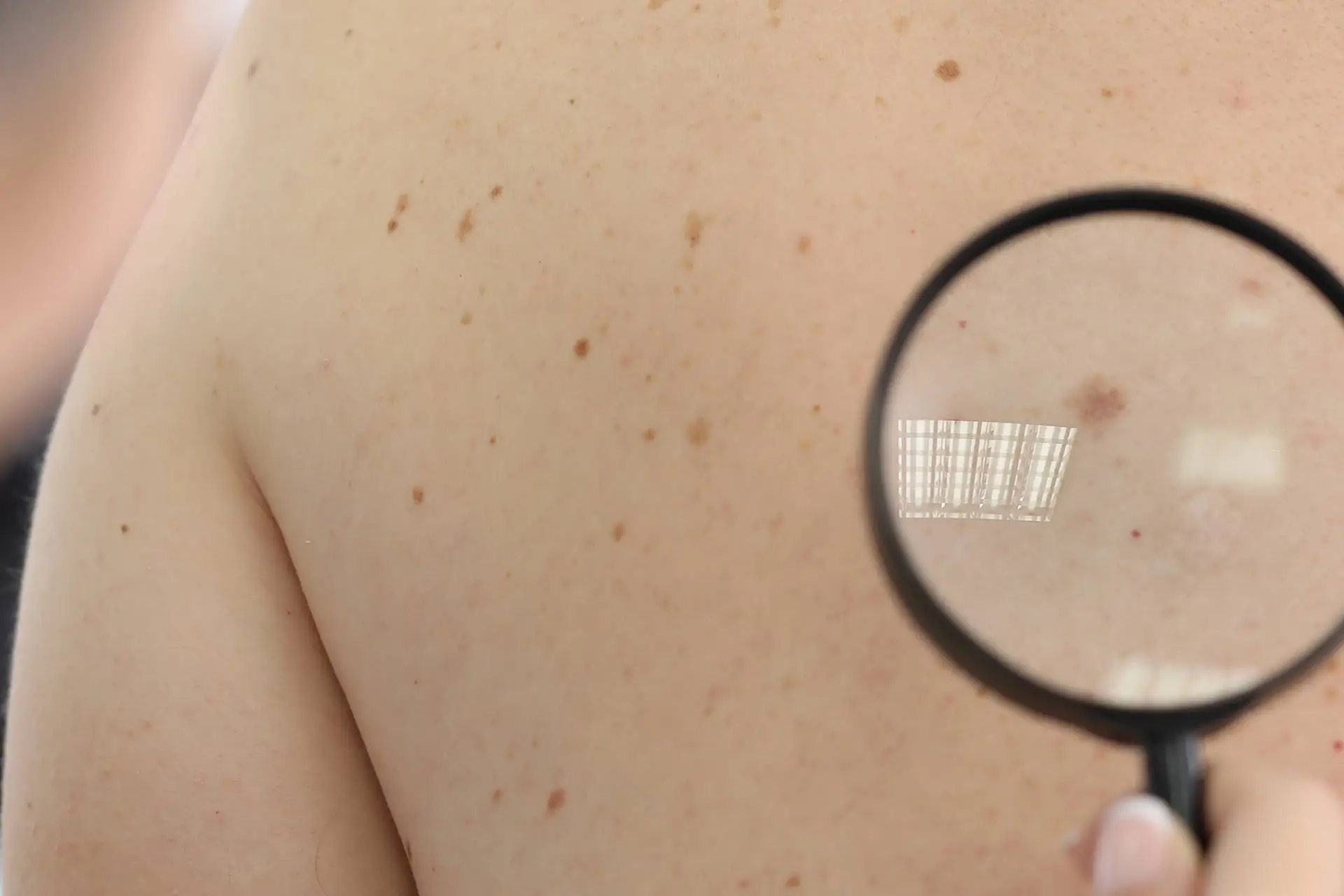 Pembrolizumab and Nivolumab Show Similar Outcomes in Advanced Melanoma in VA Cohort Study