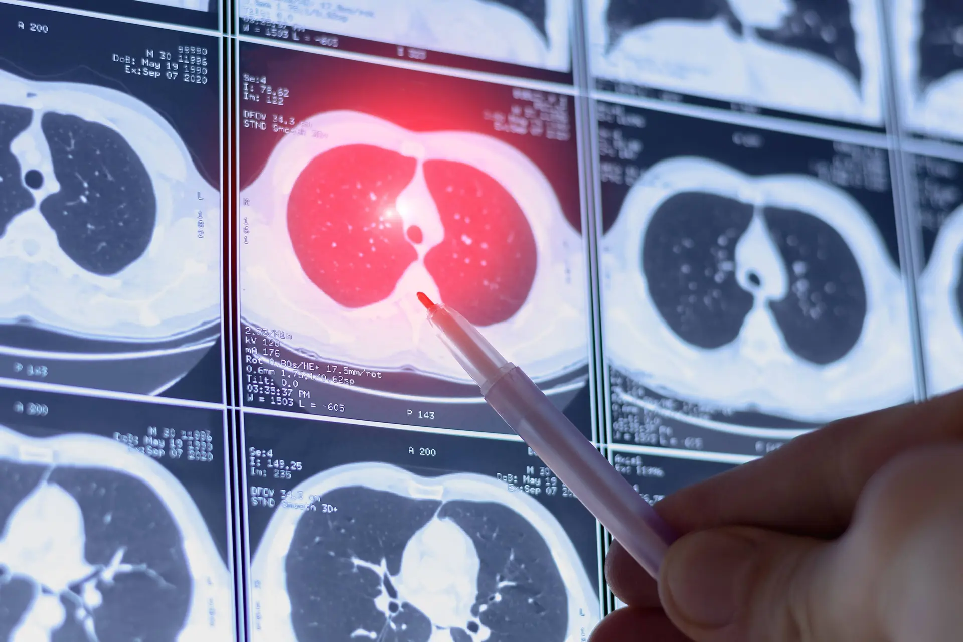 Risvutatug Rezetecan Improved Survival in Relapsed Small Cell Lung Cancer
