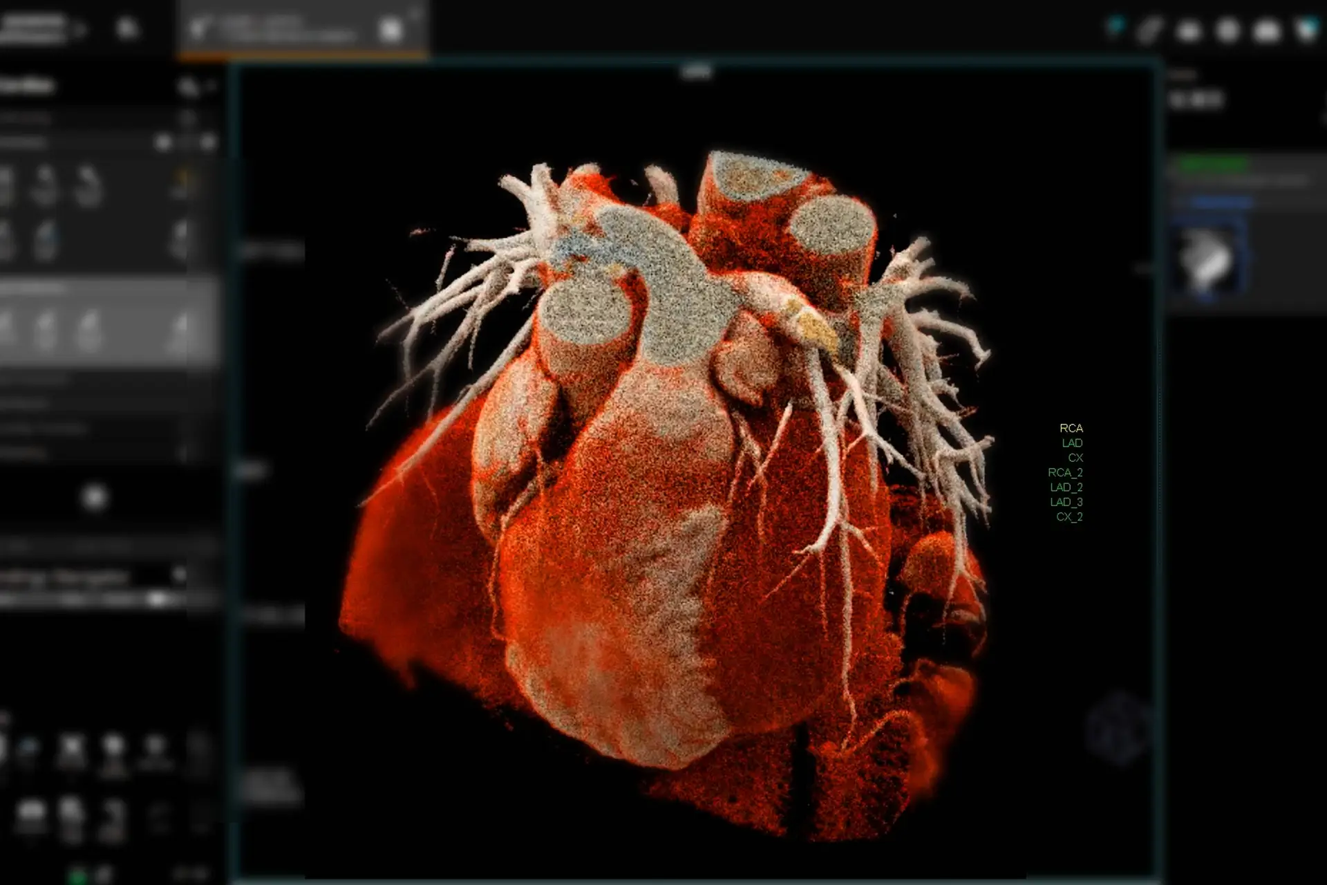 Lower FFR-CT Associated With Higher MI and Cardiovascular Death Risk