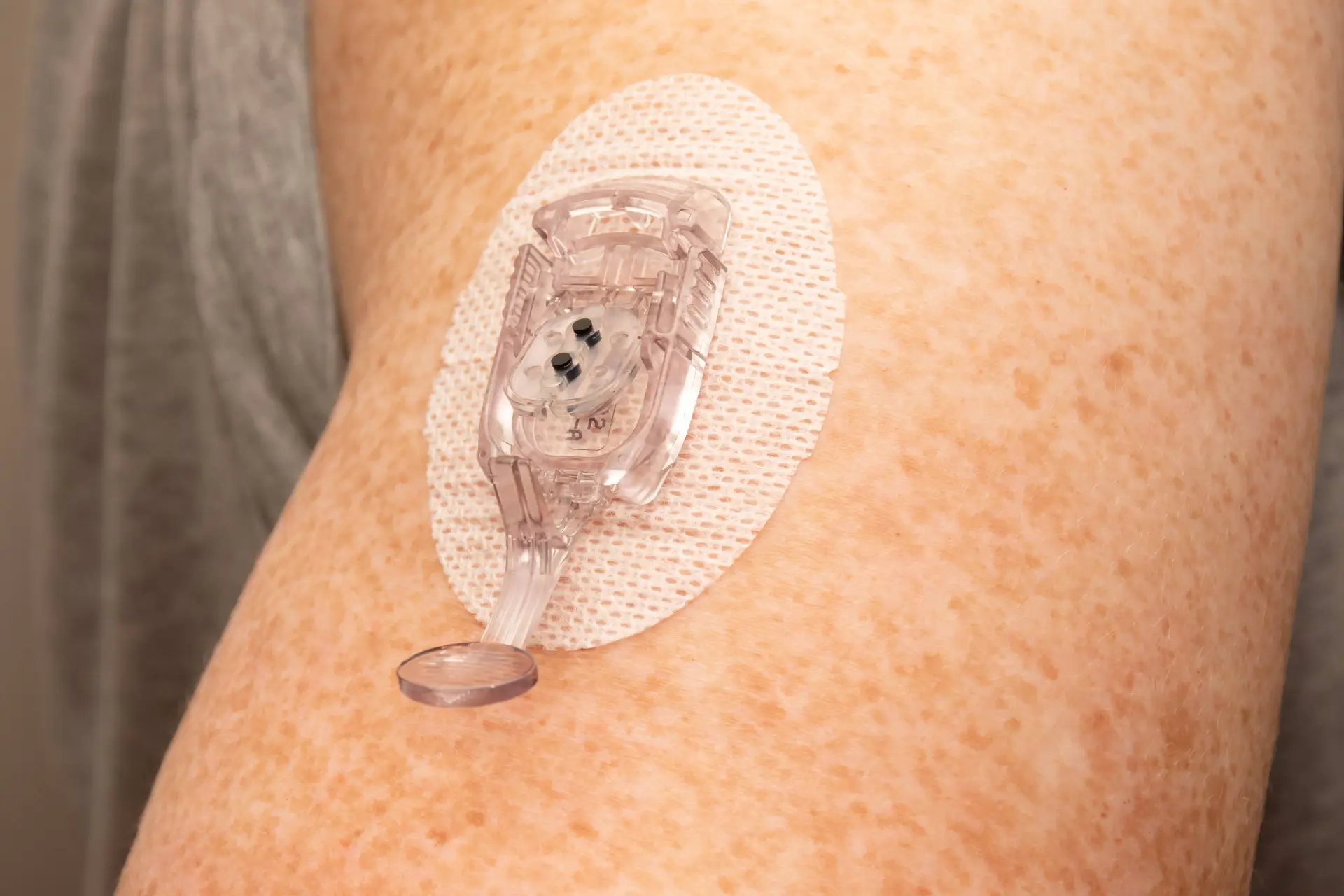 FDA Clears Mint Patch Pump; 3D Insulin Algorithm Submitted