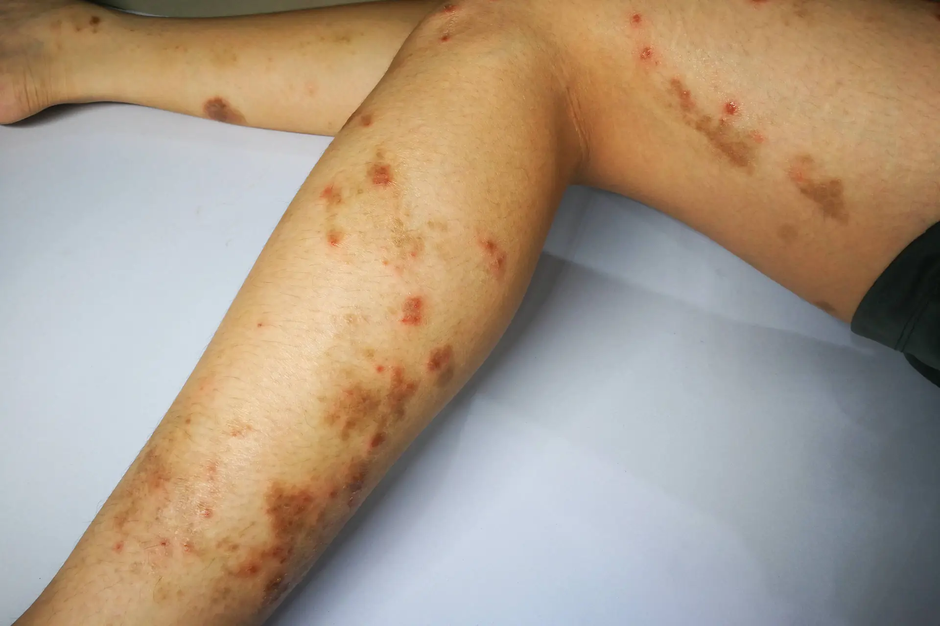 Urticaria Control Commonly Led to Omalizumab Discontinuation