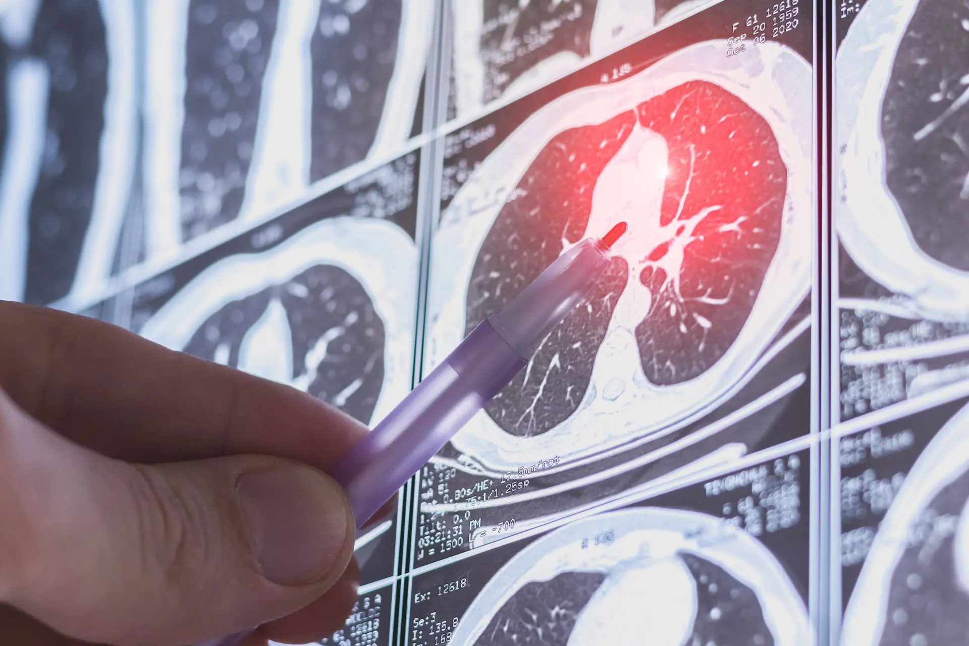 Imfinzi Plus Imdelltra Shows Interim Survival Benefit in ES-SCLC Maintenance