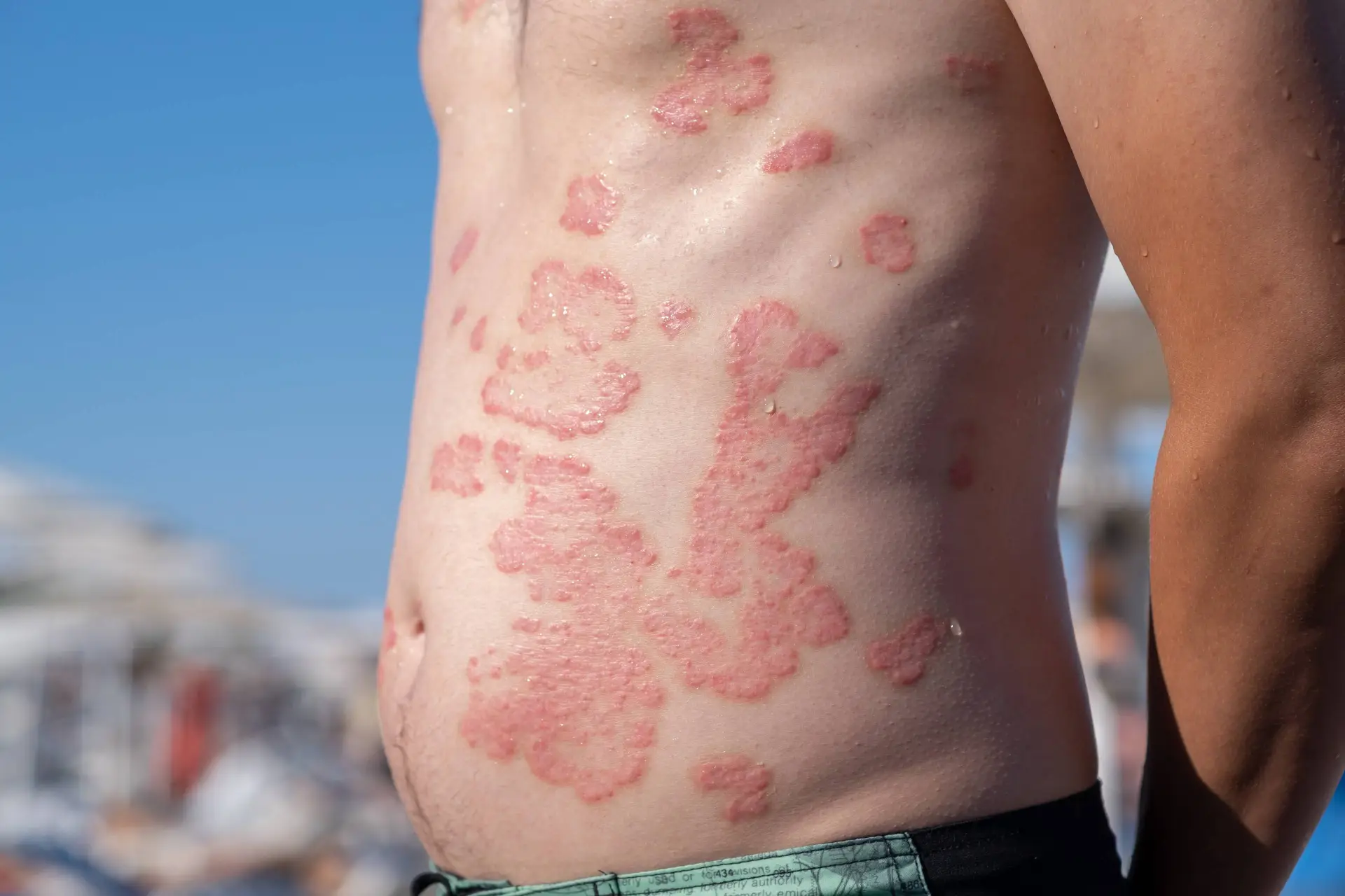 Zasocitinib Gets Priority Review for Plaque Psoriasis