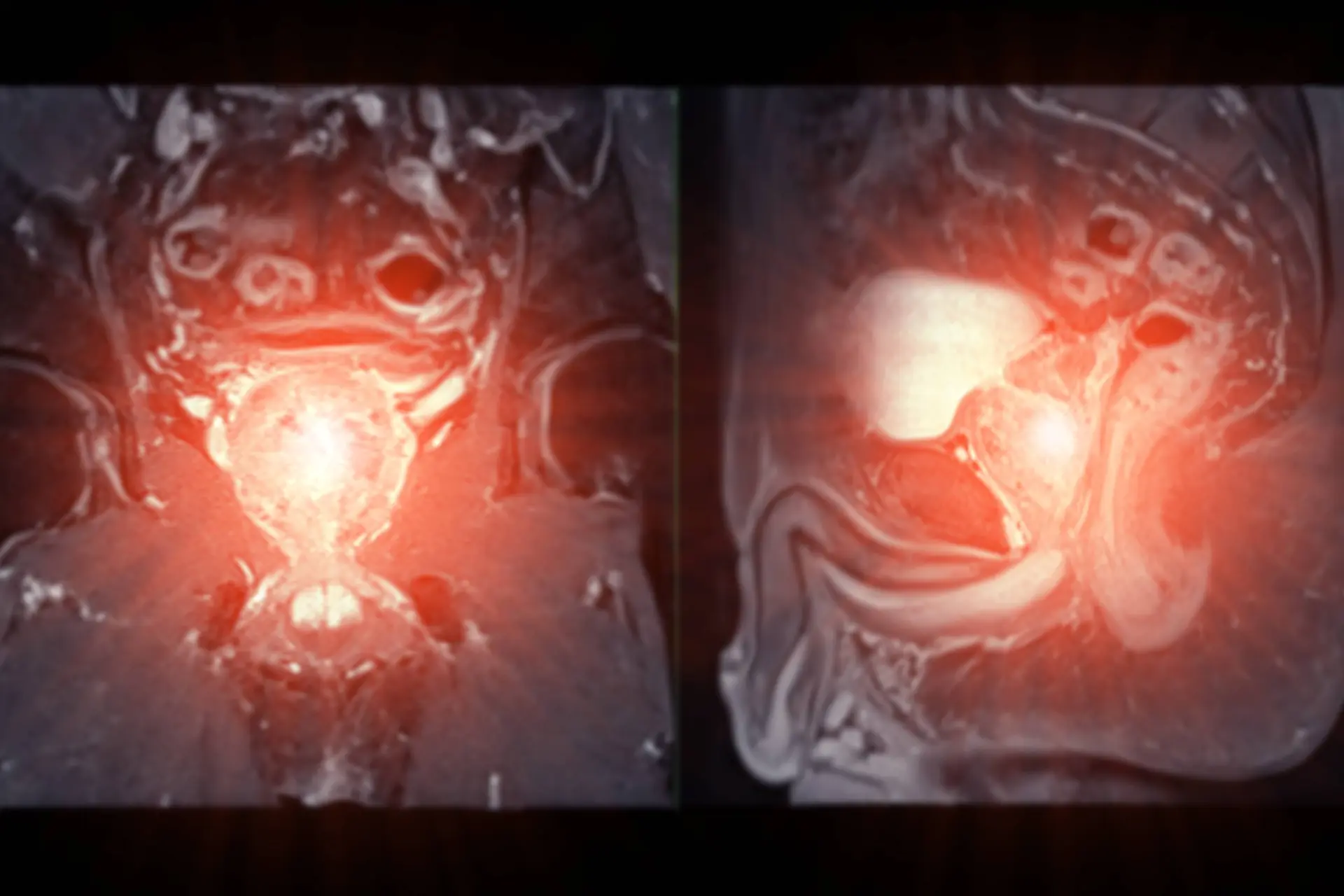 Dietary Fat Intake Associated With Mortality After Prostate Cancer