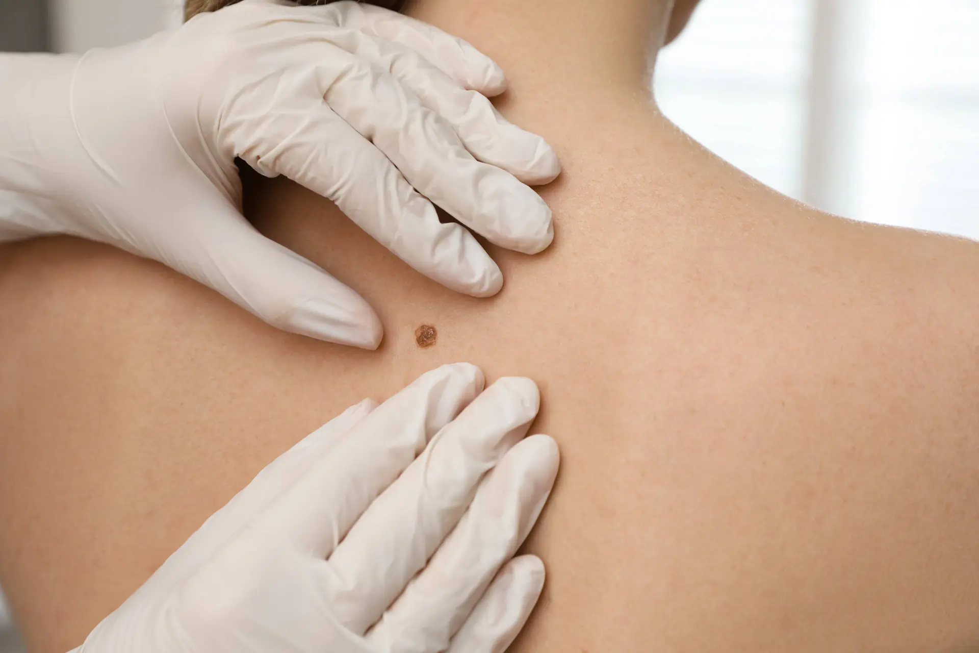 Major Pathological Response Linked to 98% 5-Year Survival With Neoadjuvant Immunotherapy in Melanoma