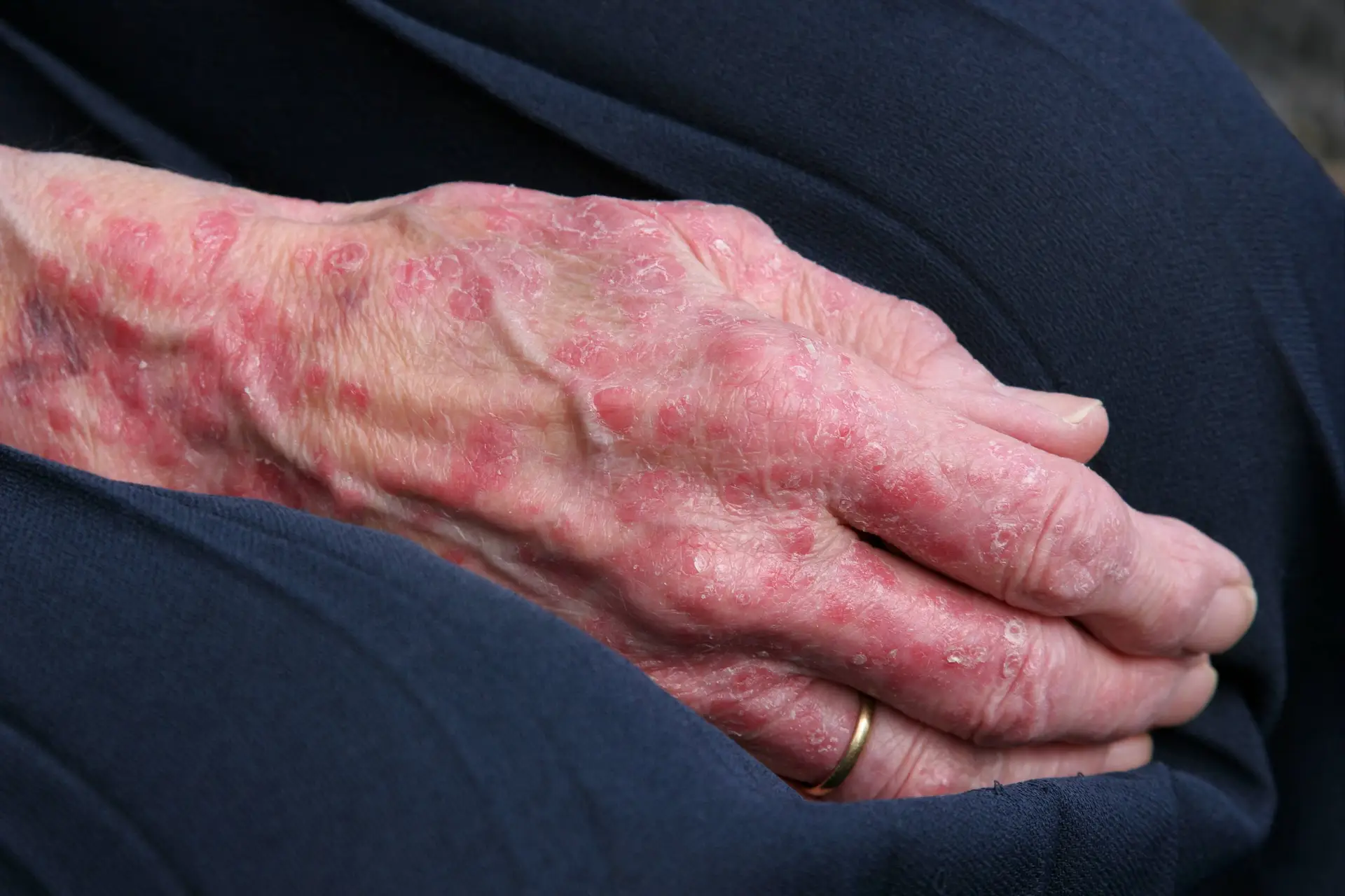 Bimekizumab Responses Sustained Through 3 Years in Psoriatic Arthritis