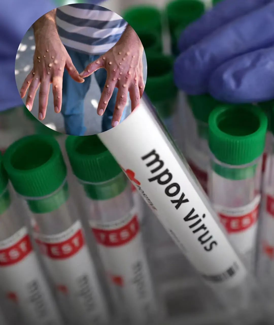 Nieuwe mpox-variant voor het eerst vastgesteld in Frankrijk