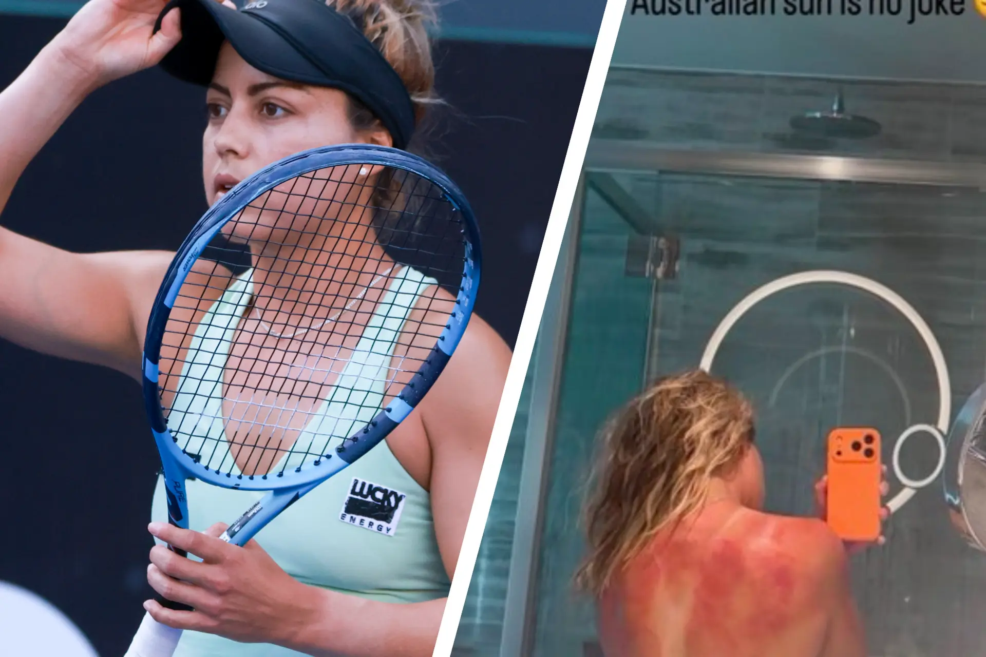 Pagando el precio: Renata Zarazua muestra dolorosa quemadura solar en preparación para el Open de Australia