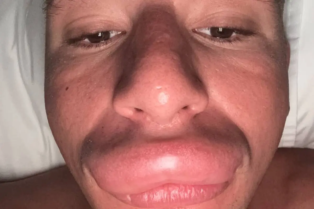 Influencer SteveWillDoIt is niet blij met zijn nieuwe lippen
