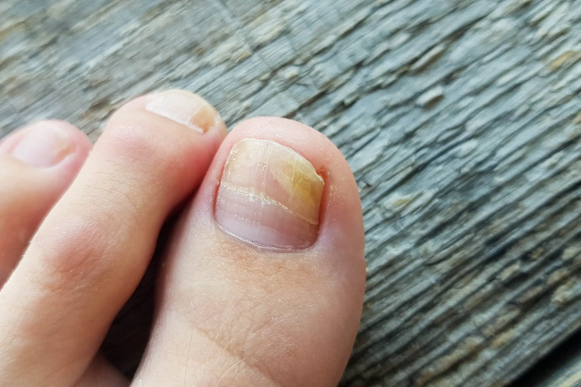 Toename van schimmelnagelinfecties in zwembaden en ruimtes waar mensen blootsvoets lopen