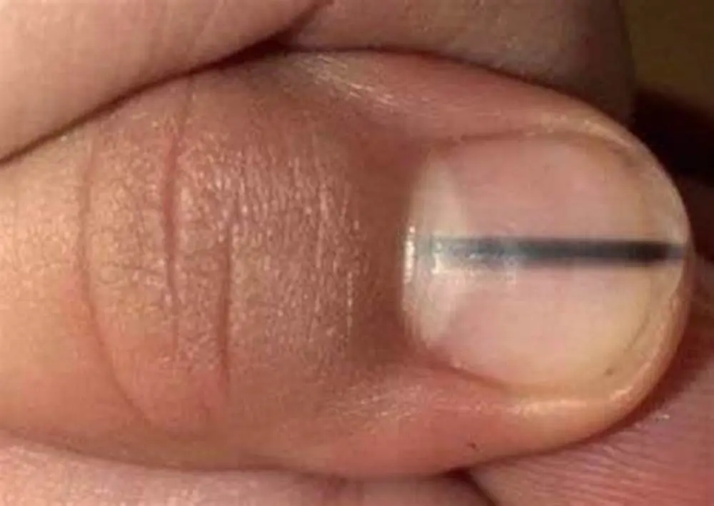 Huidkanker: deze tekenen op je nagels kunnen wijzen op melanoom