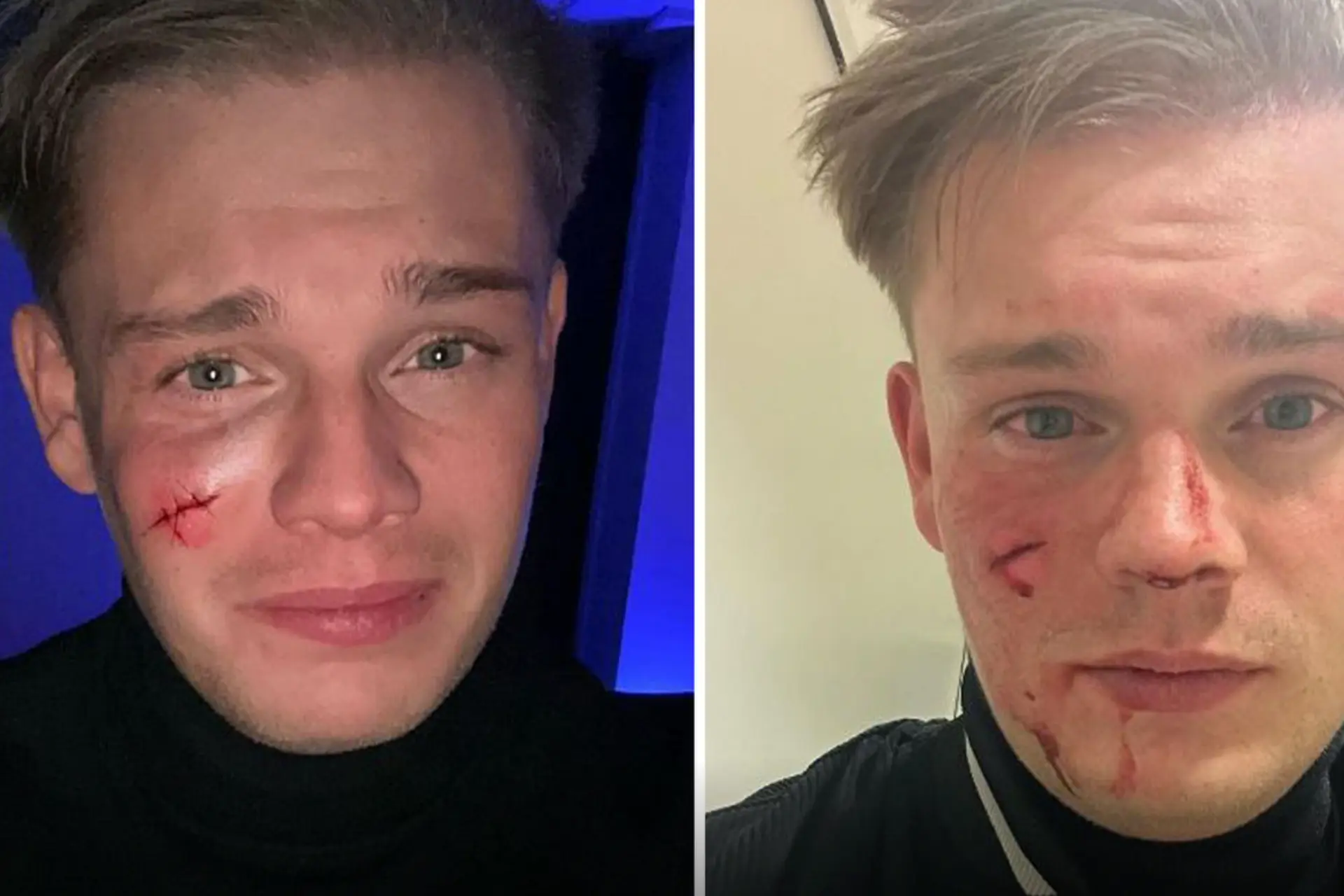 Roddelpraat-maker Dennis Schouten in bar in gezicht gestoken