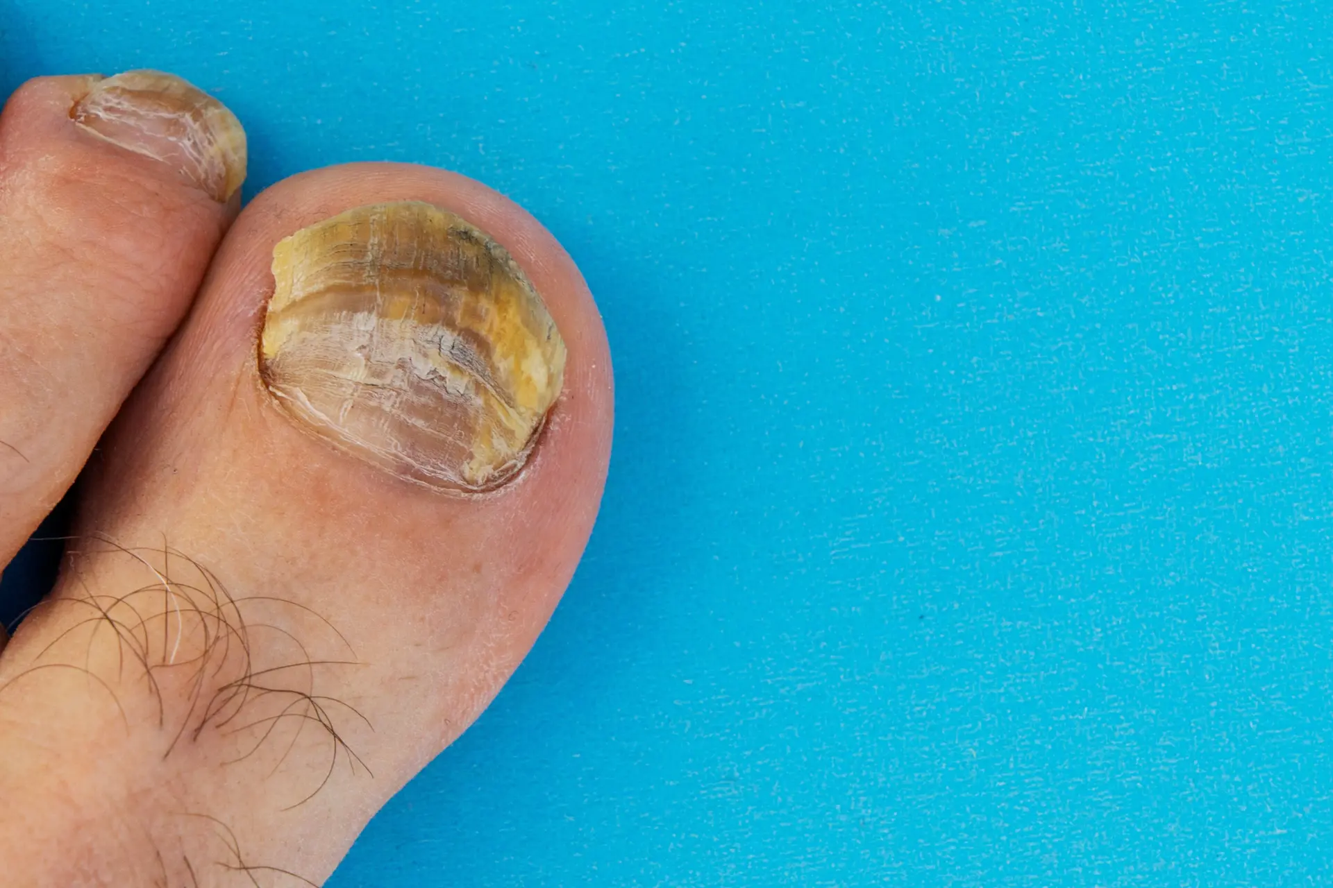 Van kanker tot hartproblemen: wat zeggen je nagels over je gezondheid?