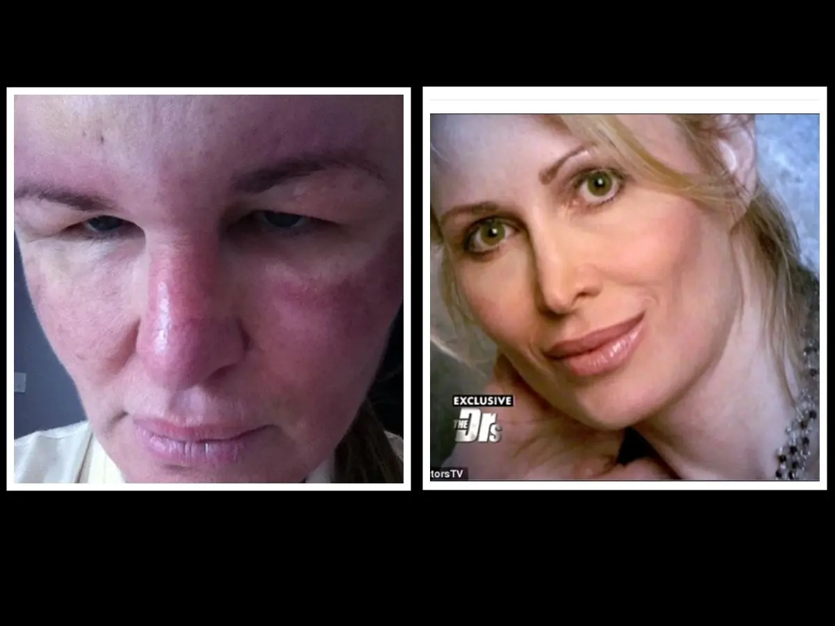 Deze mooie vrouw vond toch dat ze plastische chirurgie nodig had. Het resultaat is verschrikkelijk