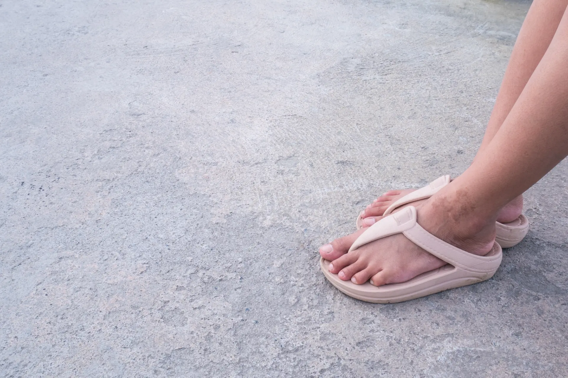 De gezondheidsrisico's van het dragen van sandalen