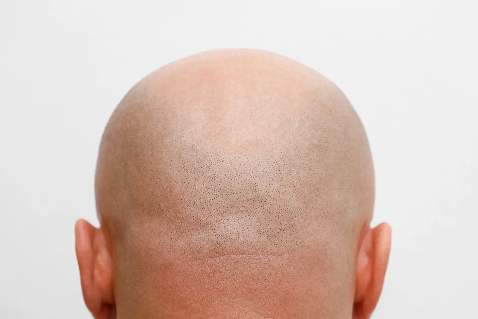 Waarom worden mannen kaal? En wat kan je er tegen doen?