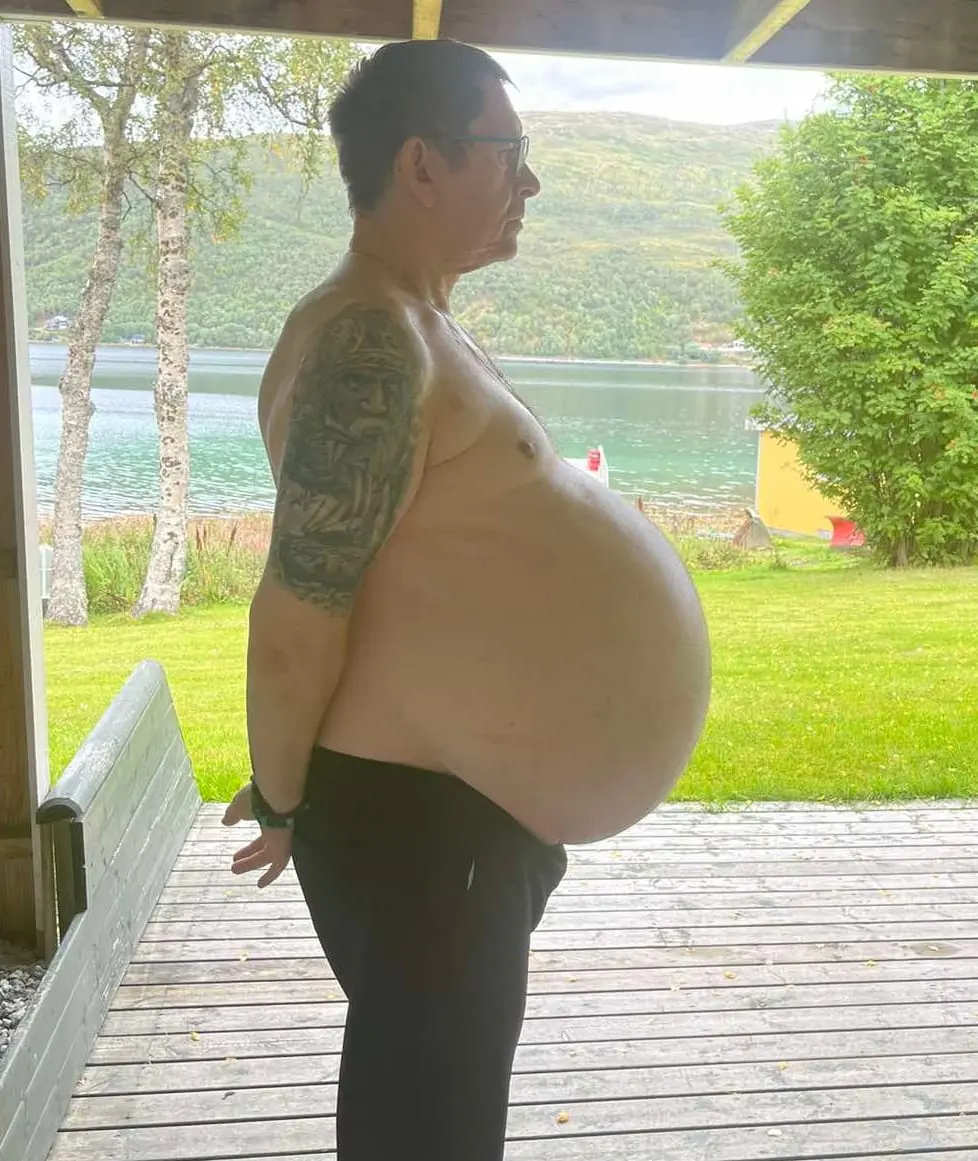 Dikke Duitser had geen bierbuik, maar een tumor van 30 kilo