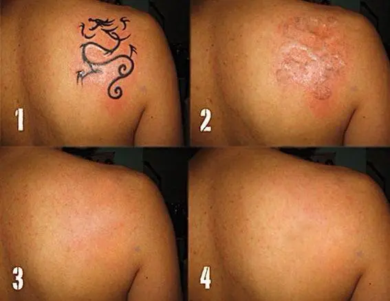 Je tatoeage weg laten laseren is niet zonder gevaar +tips