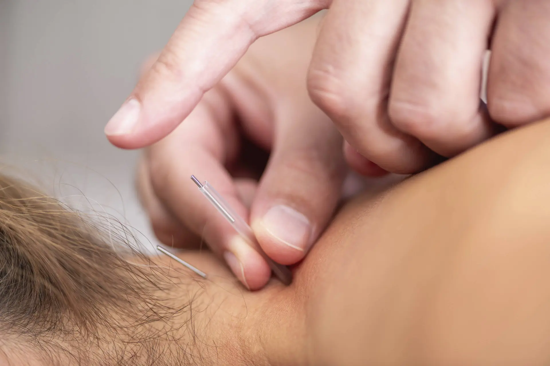 Hoe effectief is 'dry needling'? Dit zegt de wetenschap erover