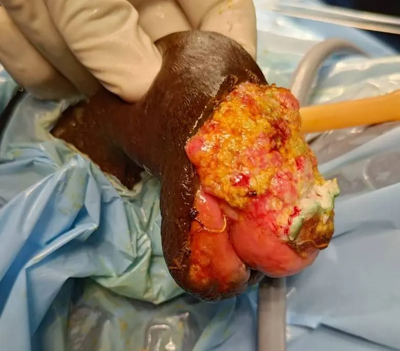 cancer-penis