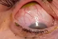 Niet voor een zwakke maag: contactlensje kwijt