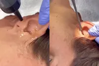 Arts haalt levende kakkerlak uit oor van vrouw