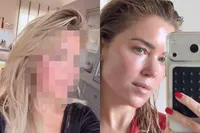 Sylvie Meis ligt dagen uit de roulatie na intensieve huidbehandeling