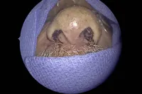 Artsen halen 150 levende beestjes uit de neus van een man