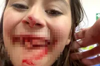 Superman slaat toe in Kielegat: tanden eruit na carnavalsklap 😳🦷