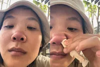 Dame ontwikkelt nieuwe neus...