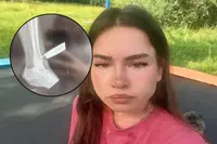 Prioriteiten op orde: meisje krijgt trampolineveer door haar been en denkt eerst aan TikTok
