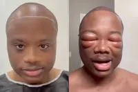 Naasir ging voor een haartransplantatie, maar of dat nou echt een goed idee was...