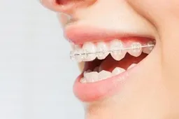 Kodėl svarbu pasirūpinti dantų tiesinimu?