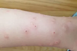 Atsargiai: šistosomų lervos, dėl jų vietoje Dusios poilsį rekomenduoja rinktis kitur