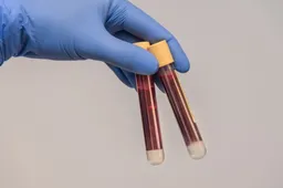 Ką reikėtų žinoti: COVID-19 ir PGR tyrimas (testas), greitasis antigeno testas