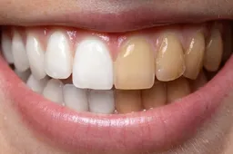 Ar pasinaudojote kompensuojamomis dantų protezavimo paslaugomis?