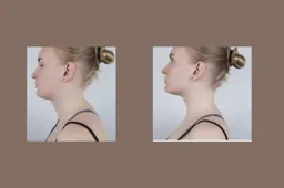 Sveikatai ir grožiui: kompleksinis gydymo paketas „našlės kuprelės“ korekcijai