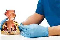 Hemorojus – liga, dėl kurios nereikia gėdytis